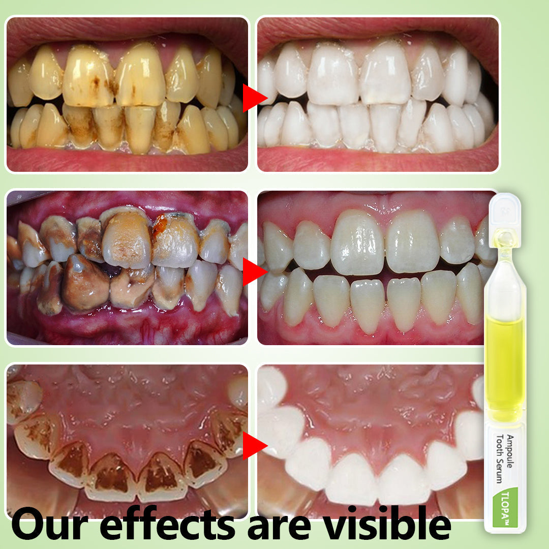 💥TLOPA™ Ampoule Toothpaste, Removal of tartar and plaque bacteria and various oral problems