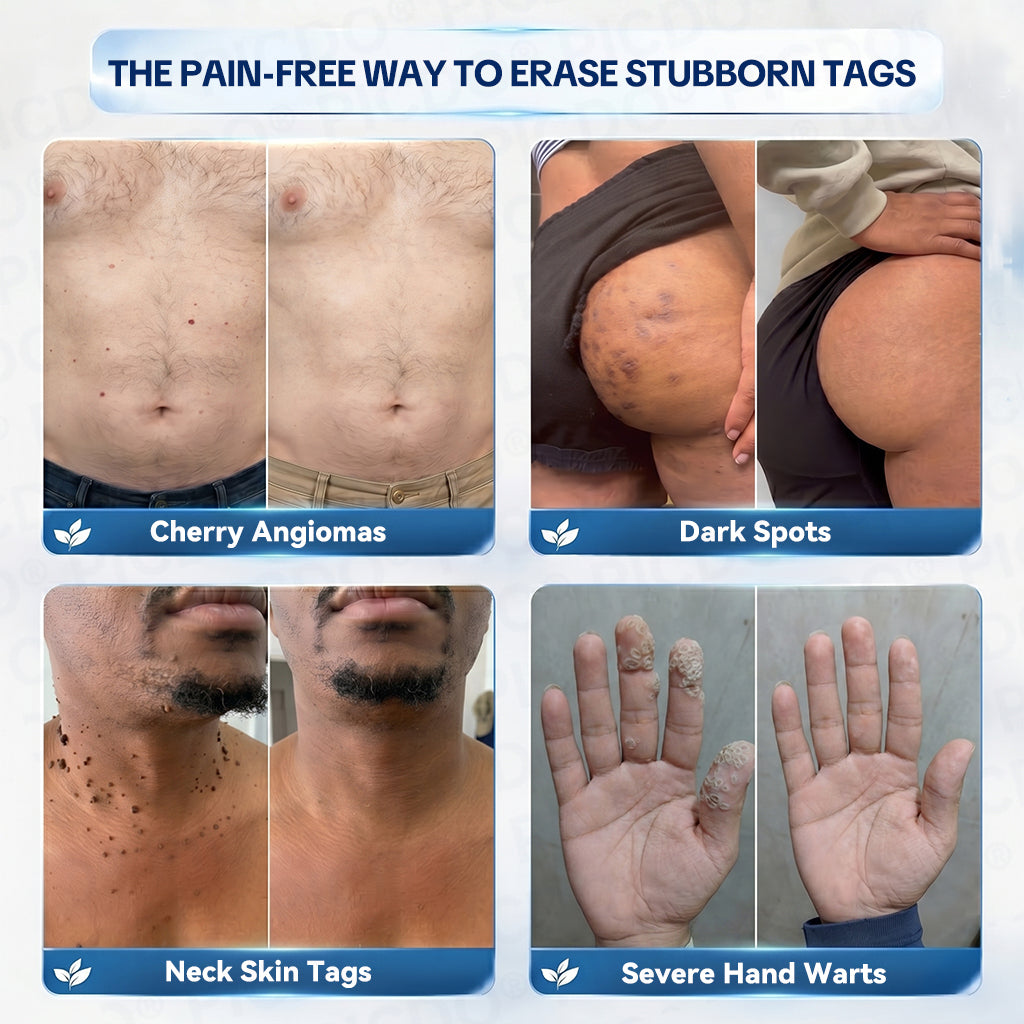 𝐏𝐡𝐚𝐫𝐦𝐚𝐜𝐢𝐬𝐭 𝐑𝐞𝐜𝐨𝐦𝐦𝐞𝐧𝐝𝐞𝐝 ✅𝐏𝐢𝐜𝐝𝐨® 7-𝐃𝐚𝐲 𝐒𝐤𝐢𝐧 𝐓𝐚𝐠 & 𝐒𝐩𝐨𝐭 𝐄𝐫𝐚𝐬𝐞𝐫 𝐂𝐫𝐞𝐚𝐦 🧴(Zero Pain, Zero 𝐒𝐜𝐚𝐫𝐬 Formula)💎