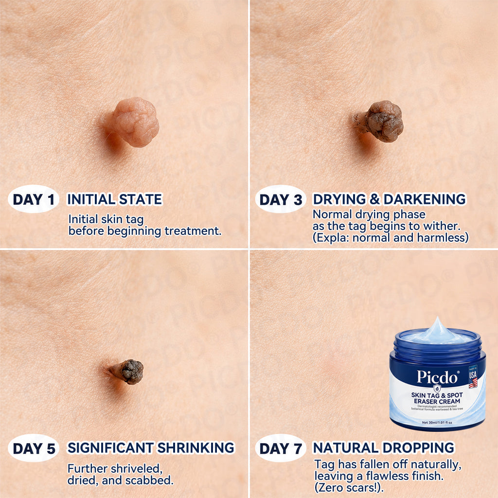 𝐏𝐡𝐚𝐫𝐦𝐚𝐜𝐢𝐬𝐭 𝐑𝐞𝐜𝐨𝐦𝐦𝐞𝐧𝐝𝐞𝐝 ✅𝐏𝐢𝐜𝐝𝐨® 7-𝐃𝐚𝐲 𝐒𝐤𝐢𝐧 𝐓𝐚𝐠 & 𝐒𝐩𝐨𝐭 𝐄𝐫𝐚𝐬𝐞𝐫 𝐂𝐫𝐞𝐚𝐦 🧴(Zero Pain, Zero 𝐒𝐜𝐚𝐫𝐬 Formula)💎