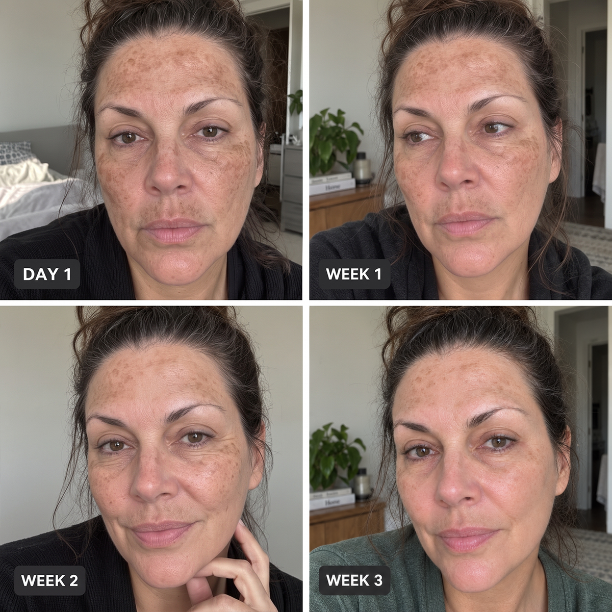 ⭐WREE® Anti-Wrinkle & Spot Removal Micro-RF Device